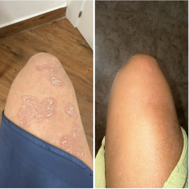 Восстанавливающий CBD Крем при Псориазе и Сухости Кожи (50мл)